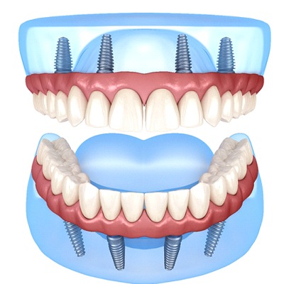 All-on-4 dental implants for upper and lower arches