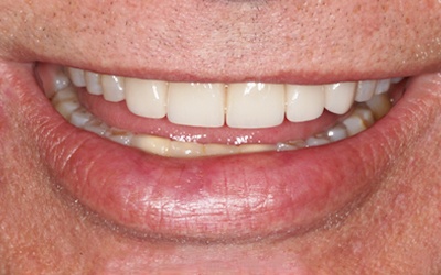 Flawelss smile after dental crown placement