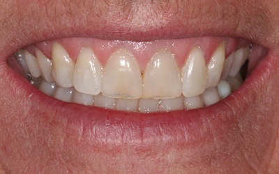 Yellowed and worn smile before treatment