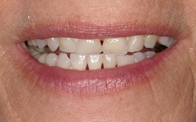 Front teeth with gaps