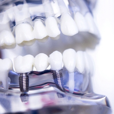 Model smile with dental implant-supported bridge
