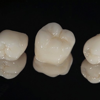 Sample dental crowns before placement