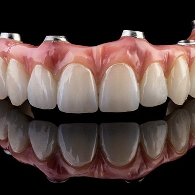 an example of hybrid dentures
