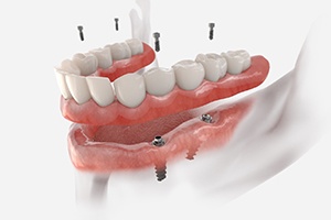 an illustration of hybrid dentures