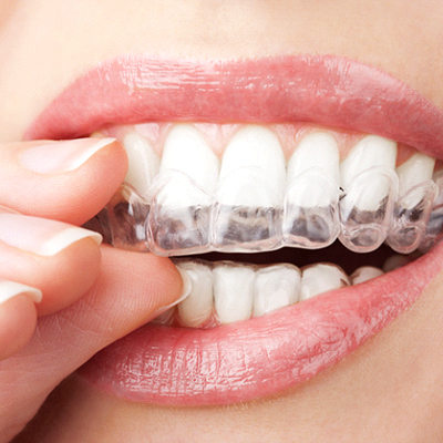 A woman being treated with Invisalign putting in a clear tray 