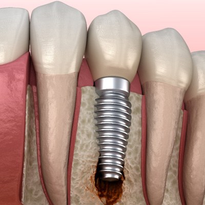 Illustration of a failed dental implant