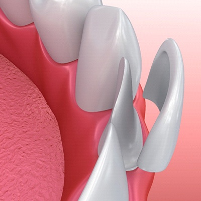 Animated smile during veneer placement