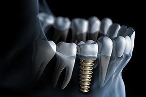 Single dental implant in bottom arch of teeth