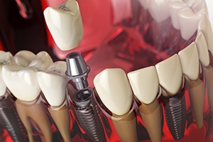 Dental implant post, abutment, crown of multiple dental implants