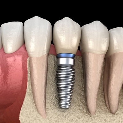 Dental implants replacing a tooth